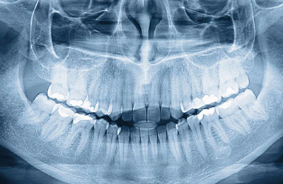 https://cms.wecarehealthcenter.org/Upload/DanpheCareCMS/radiology_Dental_OPG_list.jpg